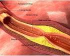 LDL Cholesterol and Heart Disease