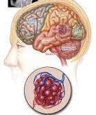 Cavernous Malformation - 20 Questions Answered
