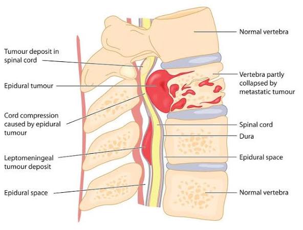 Spinal Cord Tumors in Children- Detection and Diagnosis - ACCO