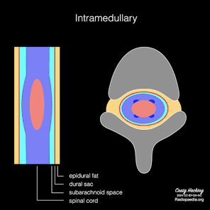 Intramedullary spinal tumors | Radiology Reference Article ...