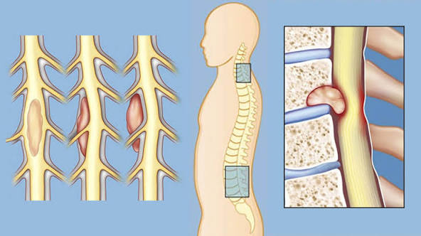 Tumors (cancer) of the spinal cord - symptoms, causes ...