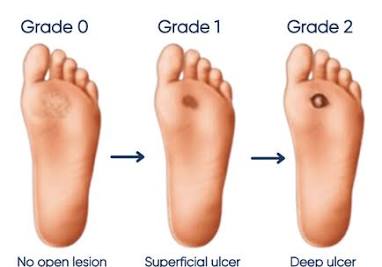 Image of Diabetic foot infections I Dr Mayo Theivendran