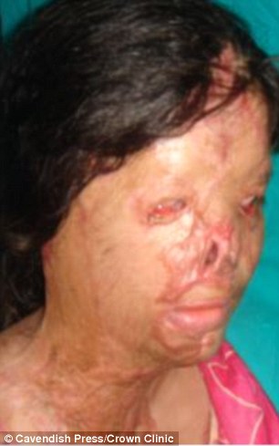 3D79CBFC00000578-0-Kanwal_lost_her_nose_in_the_attack_at_the_hands_of_a_jealous_pal-a-30_14876...jpg