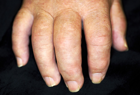 493ss_medical_images_rm_swollen_fingers.jpg