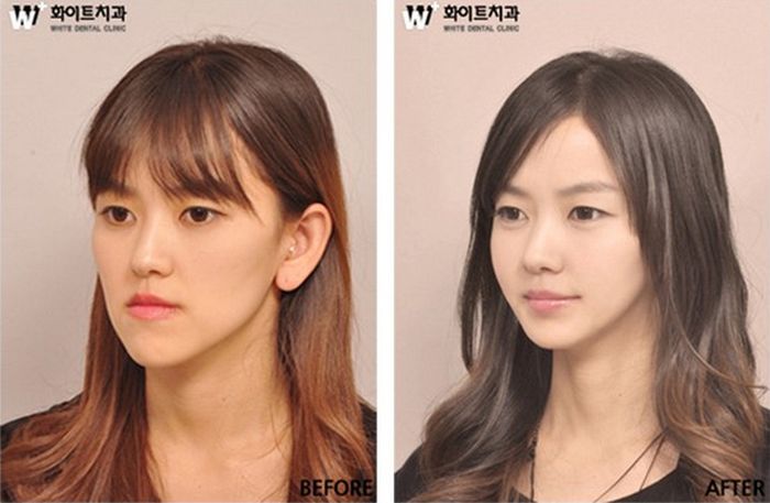 crazy_before_and_after_photos_of_korean_plastic_11.jpg
