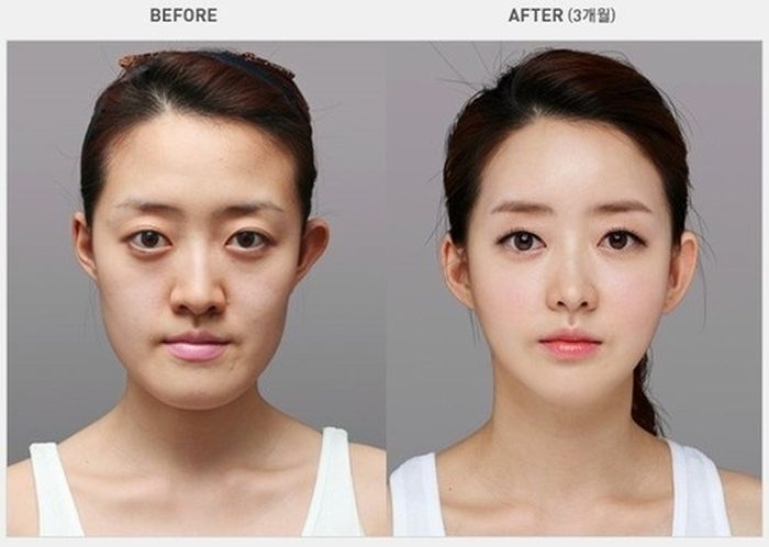 crazy_before_and_after_photos_of_korean_plastic_16.jpg