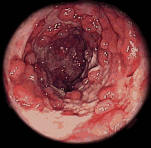crohns-disease.gif