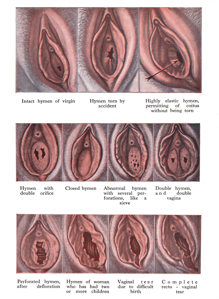 hymen-jpg.199847