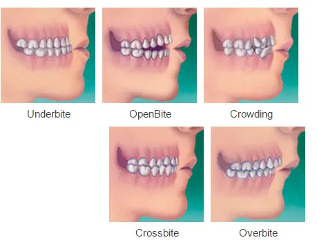 Orthodontic-treatment-from-Orthodontic-Excellence-can-effectively-treat-all-type-of-bites..webp