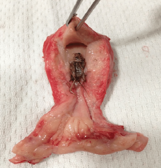Photograph-showing-a-dead-cricket-found-on-cutting-the-gross-specimen-of-uterus-within.png