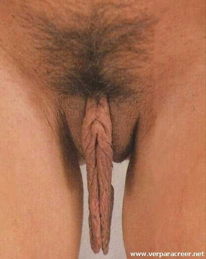 prolapse.jpg 