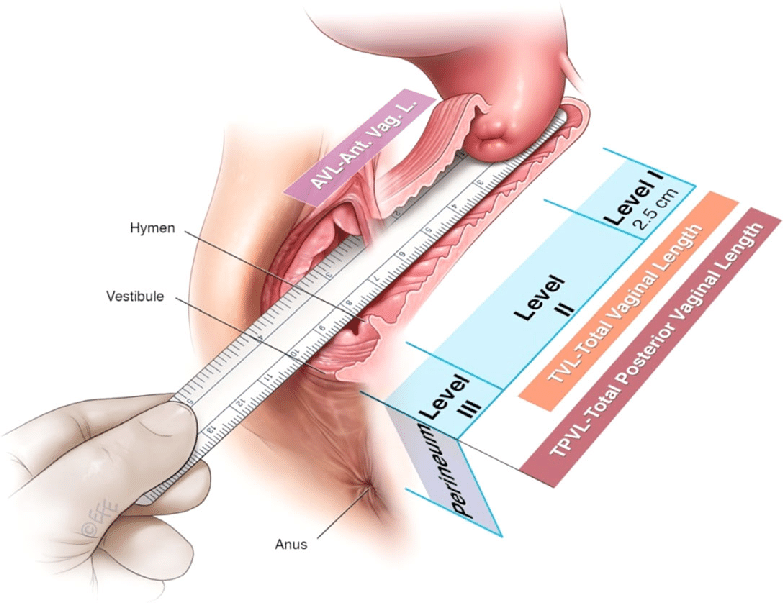 Vaginal-Levels-I-to-III-and-Vaginal-lengths-Anterior-Total-Total-Posterior-C.png