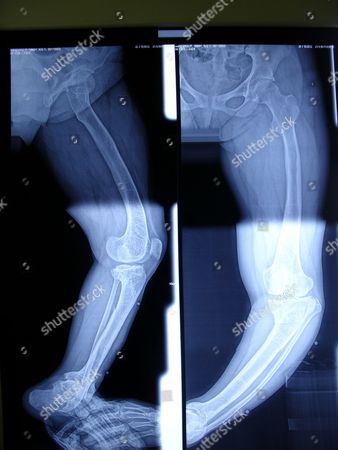 woman-with-bowed-legs-undergoes-surgery-to-correct-problem-zhenjiang-jiangsu-province-china-sh...jpg