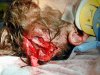 severe_scalp_laceration1.jpg