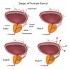 prostrate-cancer-300x300.jpg