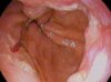 Esophageal_cancer-2626-02.jpg